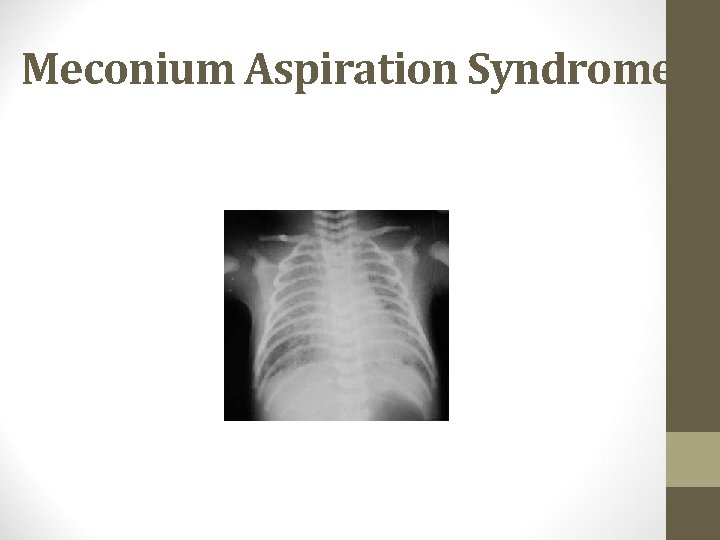 Meconium Aspiration Syndrome 