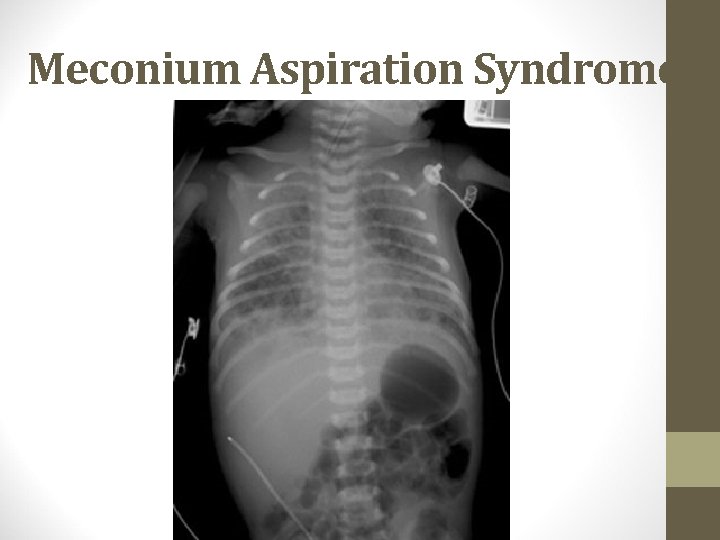 Meconium Aspiration Syndrome 