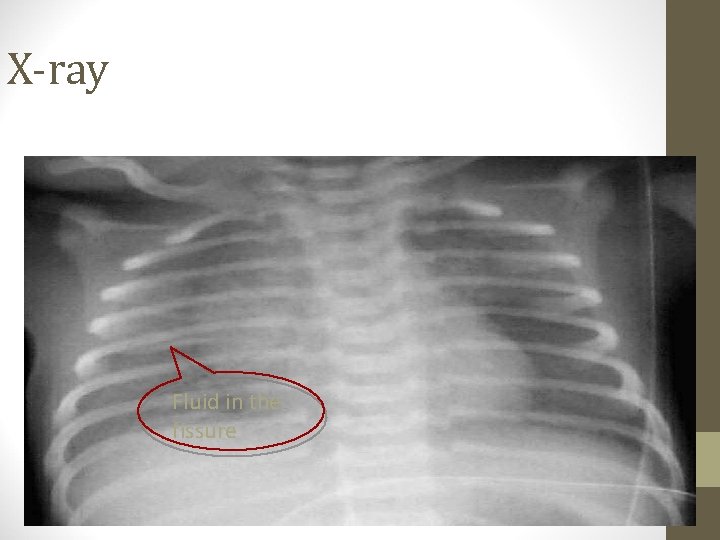 X-ray Fluid in the fissure 