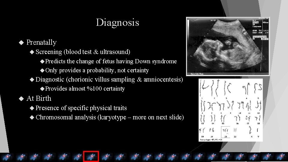 Diagnosis Prenatally Screening (blood test & ultrasound) Predicts the change of fetus having Down