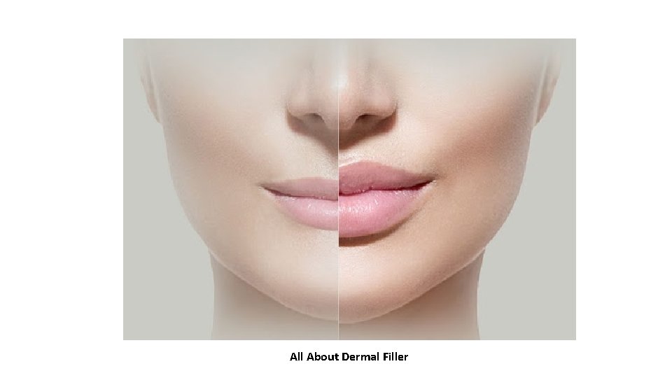 All About Dermal Filler 