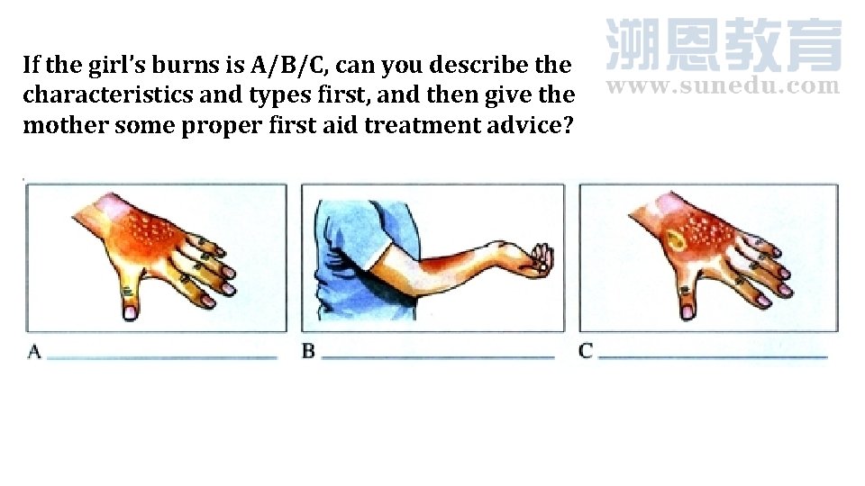 If the girl’s burns is A/B/C, can you describe the characteristics and types first,