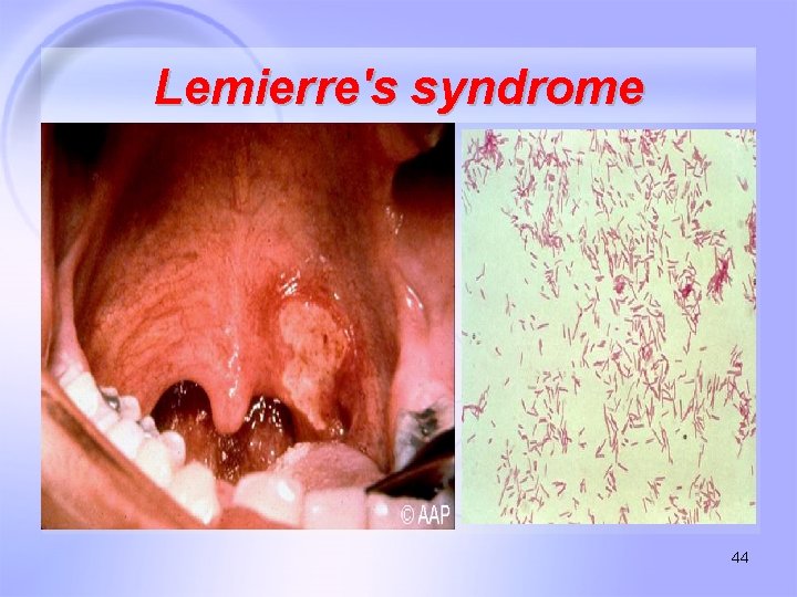 Lemierre's syndrome 44 