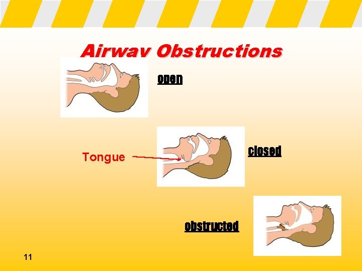 Airway Obstructions open closed Tongue obstructed 11 