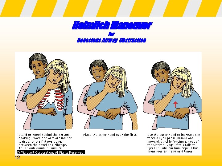 Heimlich Maneuver for Conscious Airway Obstruction 12 