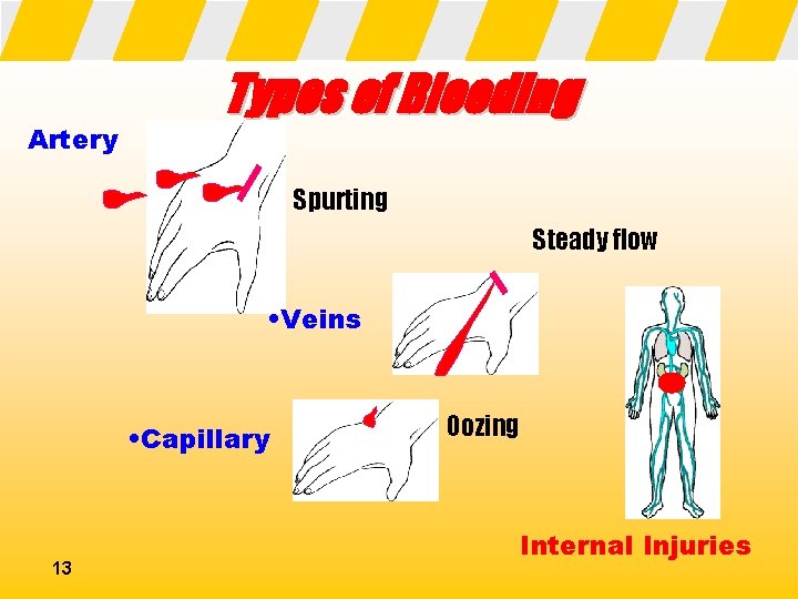 Artery Types of Bleeding Spurting Steady flow • Veins • Capillary 13 Oozing Internal