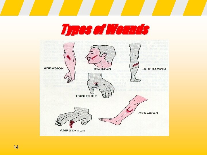 Types of Wounds 14 