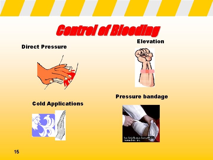 Control of Bleeding Direct Pressure Cold Applications 15 Elevation Pressure bandage 