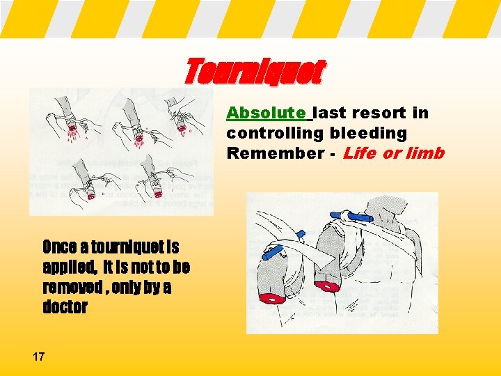 Tourniquet Absolute last resort in controlling bleeding Remember - Life or limb Once a