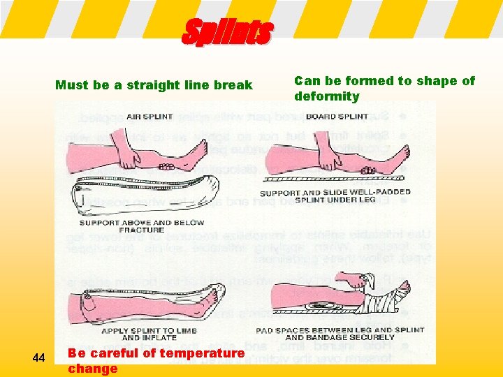 Splints Must be a straight line break 44 Be careful of temperature change Can