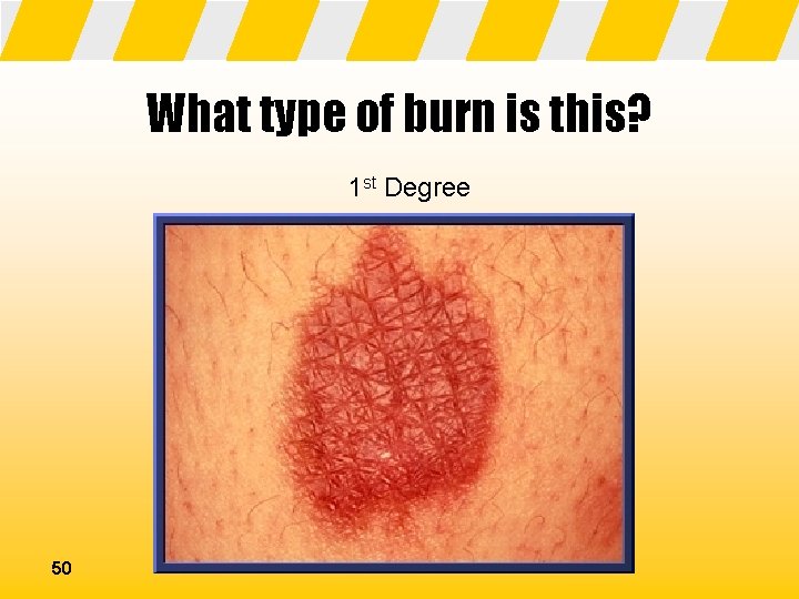 What type of burn is this? 1 st Degree 50 