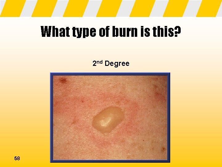 What type of burn is this? 2 nd Degree 58 
