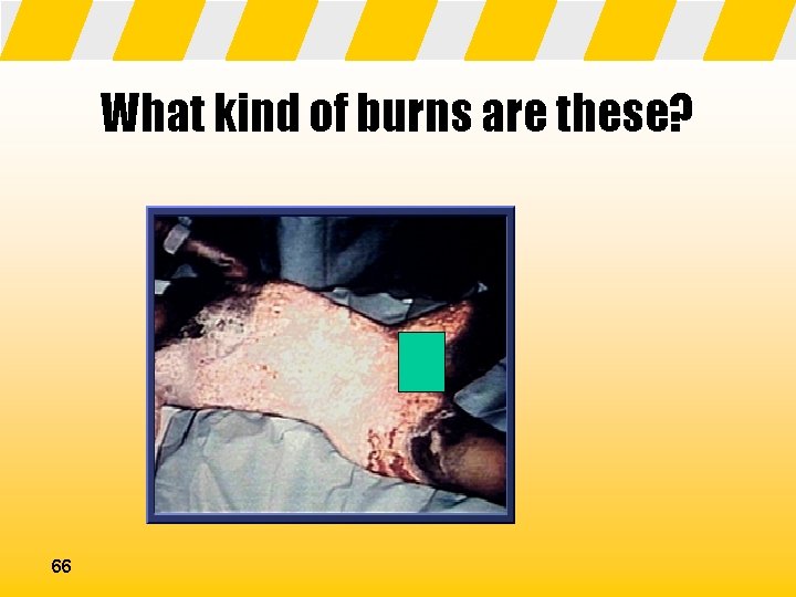 What kind of burns are these? 66 