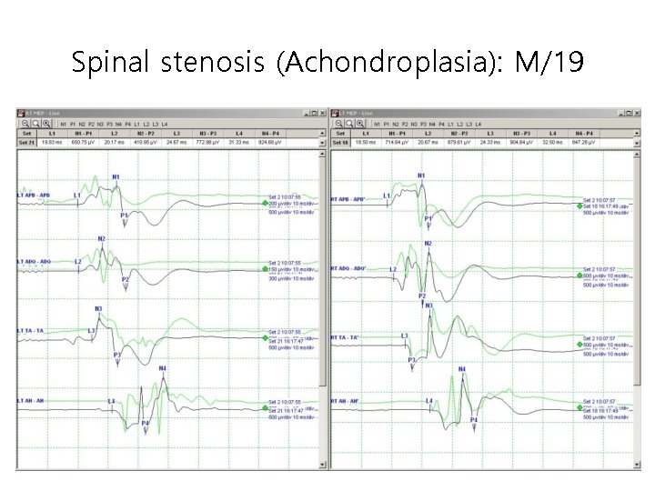 Spinal stenosis (Achondroplasia): M/19 