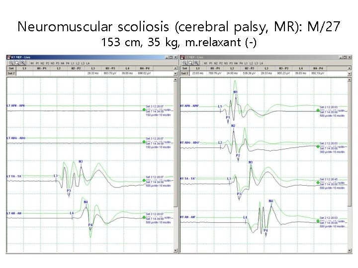 Neuromuscular scoliosis (cerebral palsy, MR): M/27 153 cm, 35 kg, m. relaxant (-) 