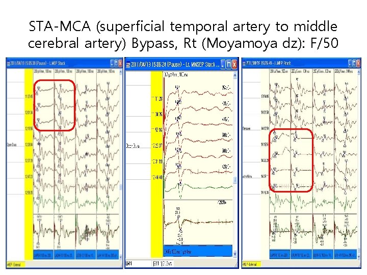 STA-MCA (superficial temporal artery to middle cerebral artery) Bypass, Rt (Moyamoya dz): F/50 