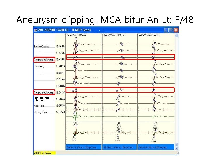 Aneurysm clipping, MCA bifur An Lt: F/48 