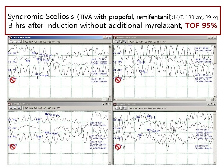 Syndromic Scoliosis (TIVA with propofol, remifentanil): 14/F, 130 cm, 39 kg 3 hrs after