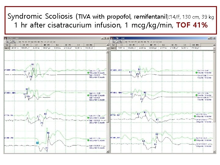 Syndromic Scoliosis (TIVA with propofol, remifentanil): 14/F, 130 cm, 39 kg 1 hr after