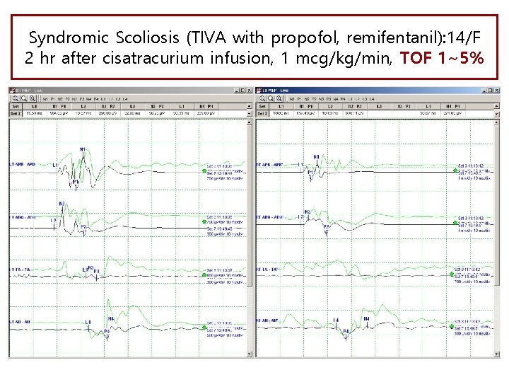 Syndromic Scoliosis (TIVA with propofol, remifentanil): 14/F 2 hr after cisatracurium infusion, 1 mcg/kg/min,