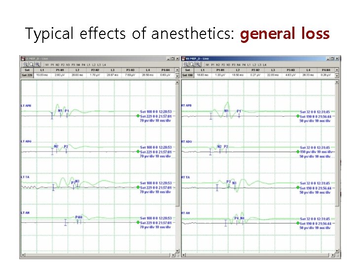 Typical effects of anesthetics: general loss 
