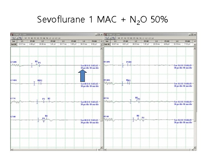 Sevoflurane 1 MAC + N 2 O 50% 