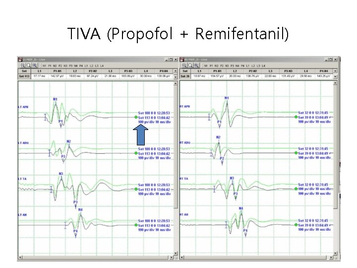 TIVA (Propofol + Remifentanil) 