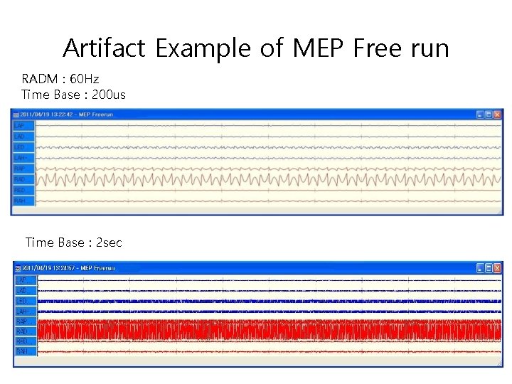 Artifact Example of MEP Free run RADM : 60 Hz Time Base : 200