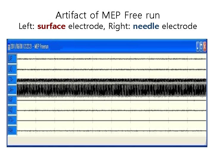 Artifact of MEP Free run Left: surface electrode, Right: needle electrode 