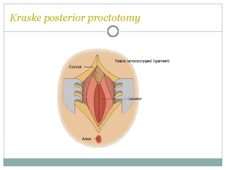 Kraske posterior proctotomy  Kraske posterior proctotomy