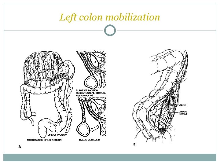 Left colon mobilization  Left colon mobilization