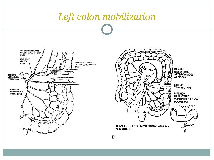 Left colon mobilization  Left colon mobilization
