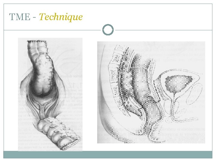 TME - Technique  TME - Technique