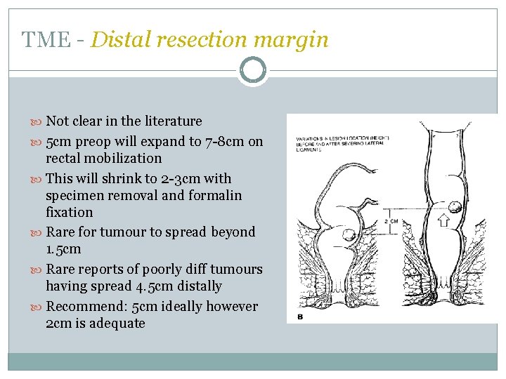TME - Distal resection margin Not clear in the literature 5 cm preop will TME - Distal resection margin Not clear in the literature 5 cm preop will