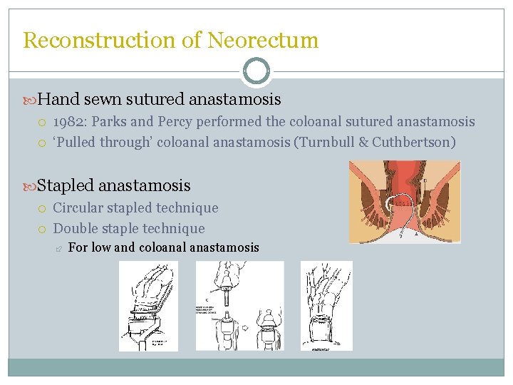 Reconstruction of Neorectum Hand sewn sutured anastamosis 1982: Parks and Percy performed the coloanal Reconstruction of Neorectum Hand sewn sutured anastamosis 1982: Parks and Percy performed the coloanal
