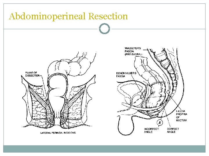 Abdominoperineal Resection  Abdominoperineal Resection