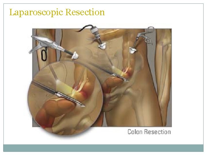 Laparoscopic Resection  Laparoscopic Resection