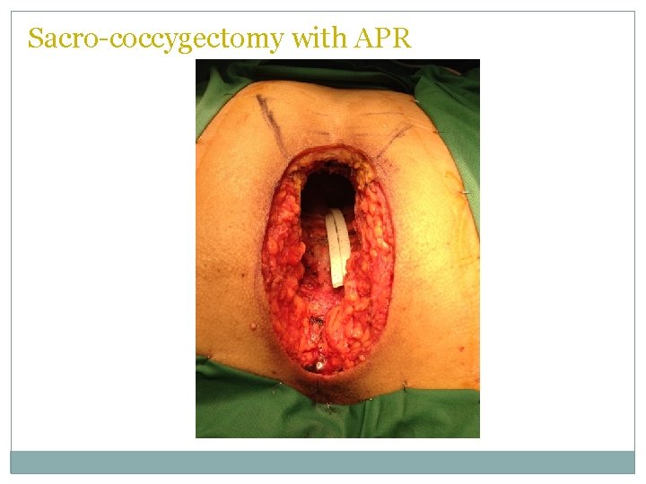 Sacro-coccygectomy with APR  Sacro-coccygectomy with APR