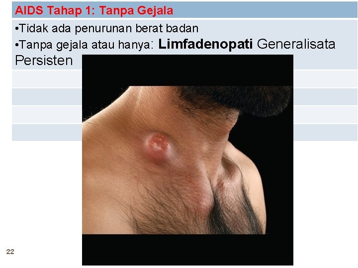 AIDS Tahap 1: Tanpa Gejala • Tidak ada penurunan berat badan • Tanpa gejala