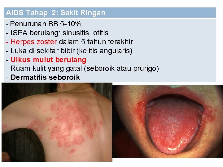 AIDS Tahap 2: Sakit Ringan - Penurunan BB 5 -10% - ISPA berulang: sinusitis,