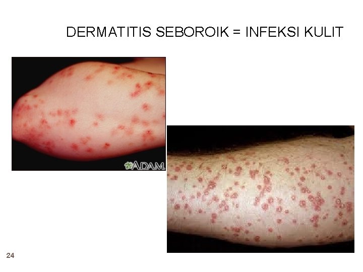 DERMATITIS SEBOROIK = INFEKSI KULIT 24 DERMATITIS SEBOROIK = INFEKSI KULIT 24