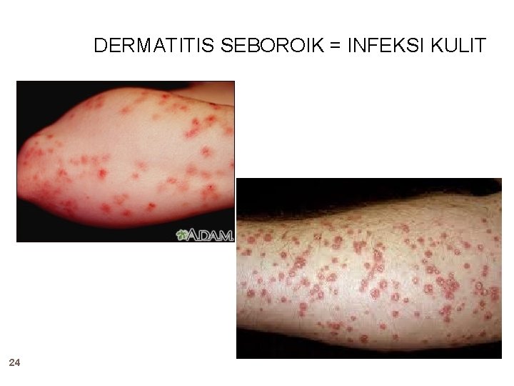 DERMATITIS SEBOROIK = INFEKSI KULIT 24 