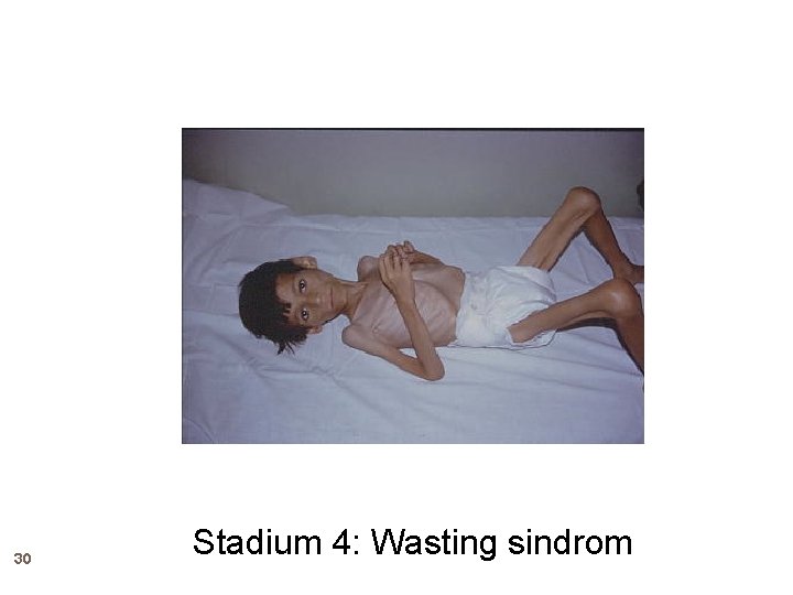 30 Stadium 4: Wasting sindrom 30 Stadium 4: Wasting sindrom