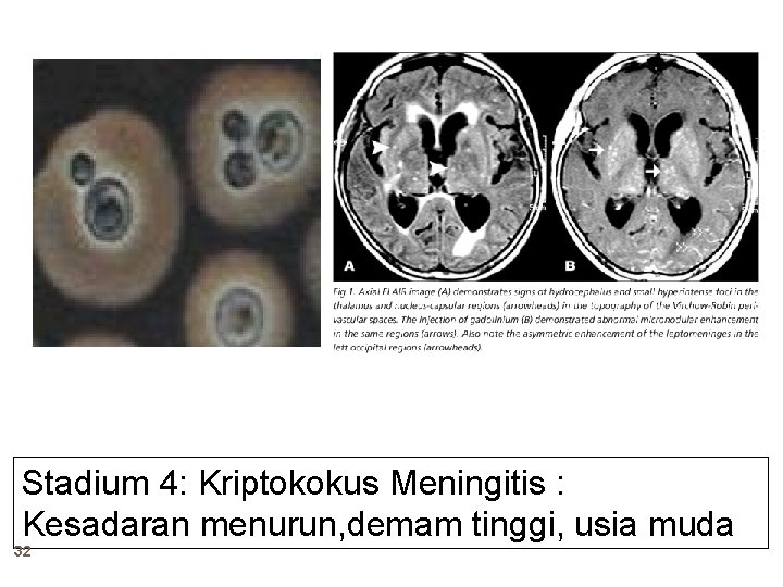 Stadium 4: Kriptokokus Meningitis : Kesadaran menurun, demam tinggi, usia muda 32 