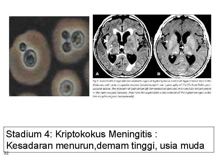 Stadium 4: Kriptokokus Meningitis : Kesadaran menurun, demam tinggi, usia muda 32 Stadium 4: Kriptokokus Meningitis : Kesadaran menurun, demam tinggi, usia muda 32