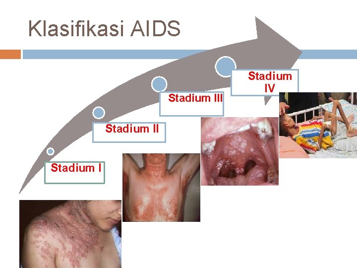 Klasifikasi AIDS Stadium III Stadium IV 