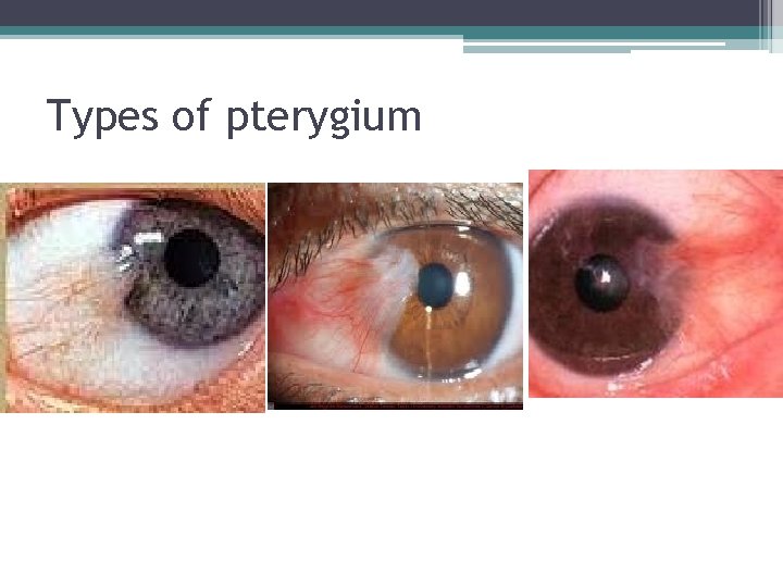 Types of pterygium 