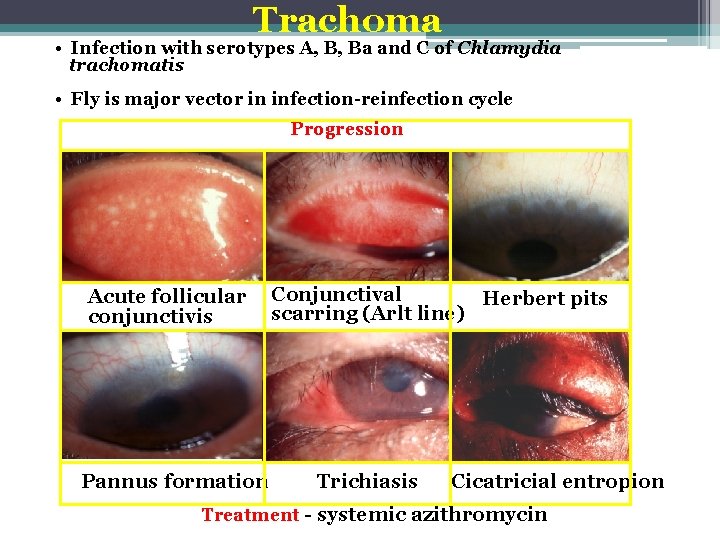 Trachoma • Infection with serotypes A, B, Ba and C of Chlamydia trachomatis •