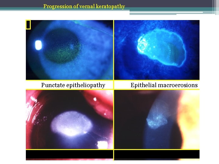 Progression of vernal keratopathy Punctate epitheliopathy Plaque formation (shield ulcer) Epithelial macroerosions Subepithelial scarring