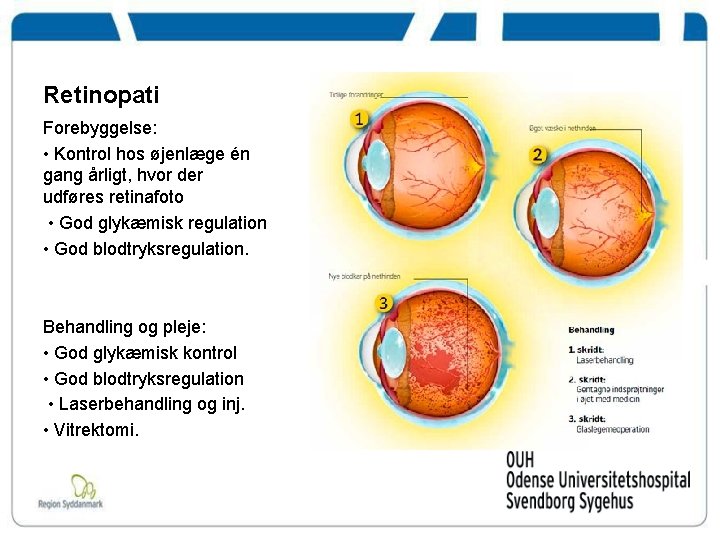 Retinopati Forebyggelse: • Kontrol hos øjenlæge én gang årligt, hvor der udføres retinafoto •